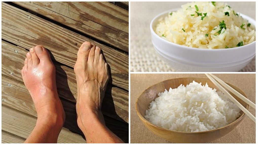 A rice-based diet is recommended for people with gout. 